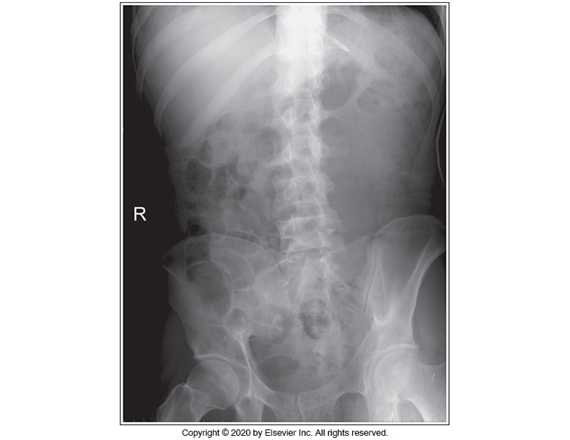 <p>Identify the main problem of the image below (AP Supine abdomen)</p><p>The image is taken on full inspiration.</p><p></p><p>The MCP is tilted anteriorly.</p><p>&nbsp;</p><p>Patient is in an LPO position.</p><p>&nbsp;</p><p>Patient is in an RPO position.</p>