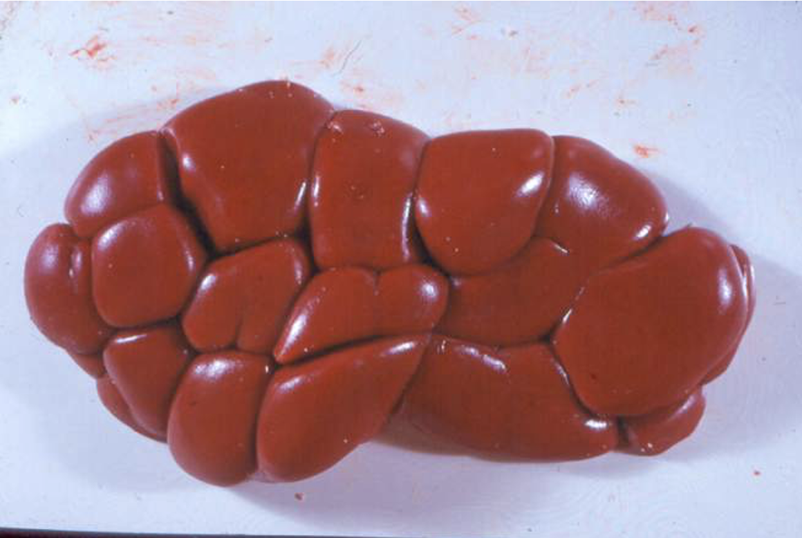 <p>small white foci in tubules</p>