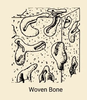 <p>Woven Bone</p>