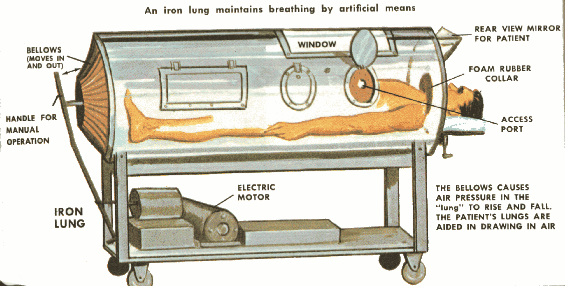 <ul><li><p>full body surrounded by machine (Polio) </p></li></ul><p></p>