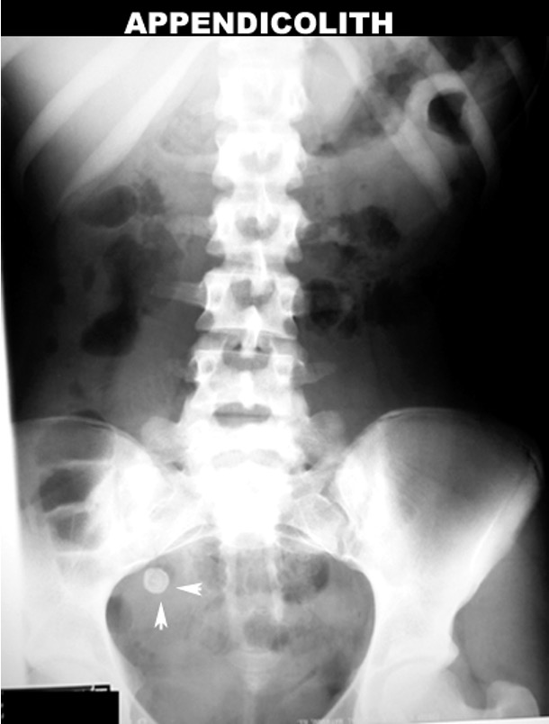 <p>stone in appendix</p>