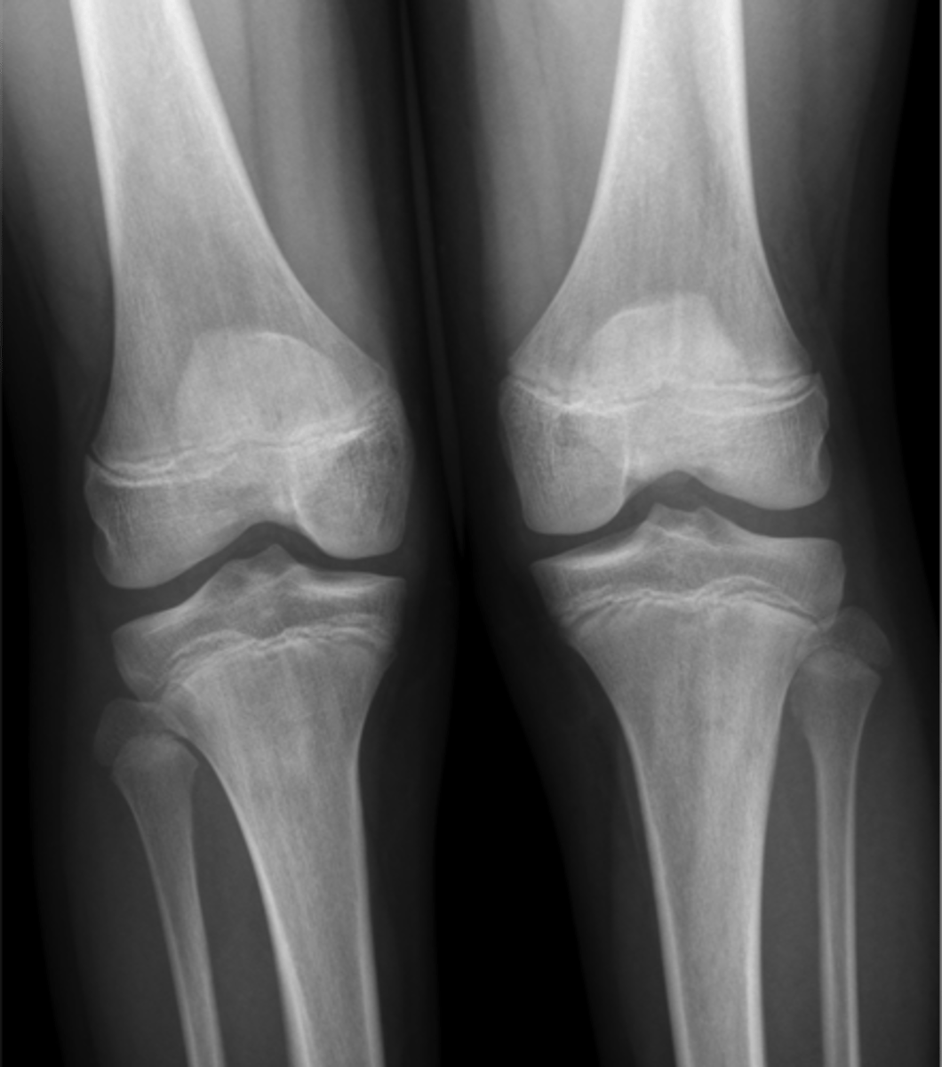 <p><strong>Lower Extremity Knee</strong> Plain films include:</p><p></p><p><strong>_________</strong> – joint space narrowing or calcification of the cartilage</p>