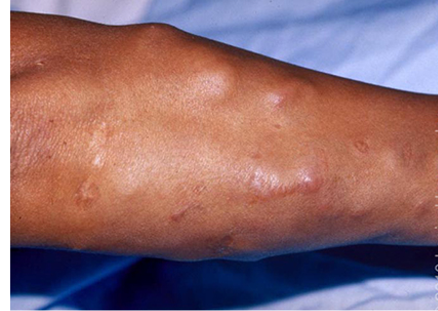 <p>systemic granulomatous dz of unknown cause</p>