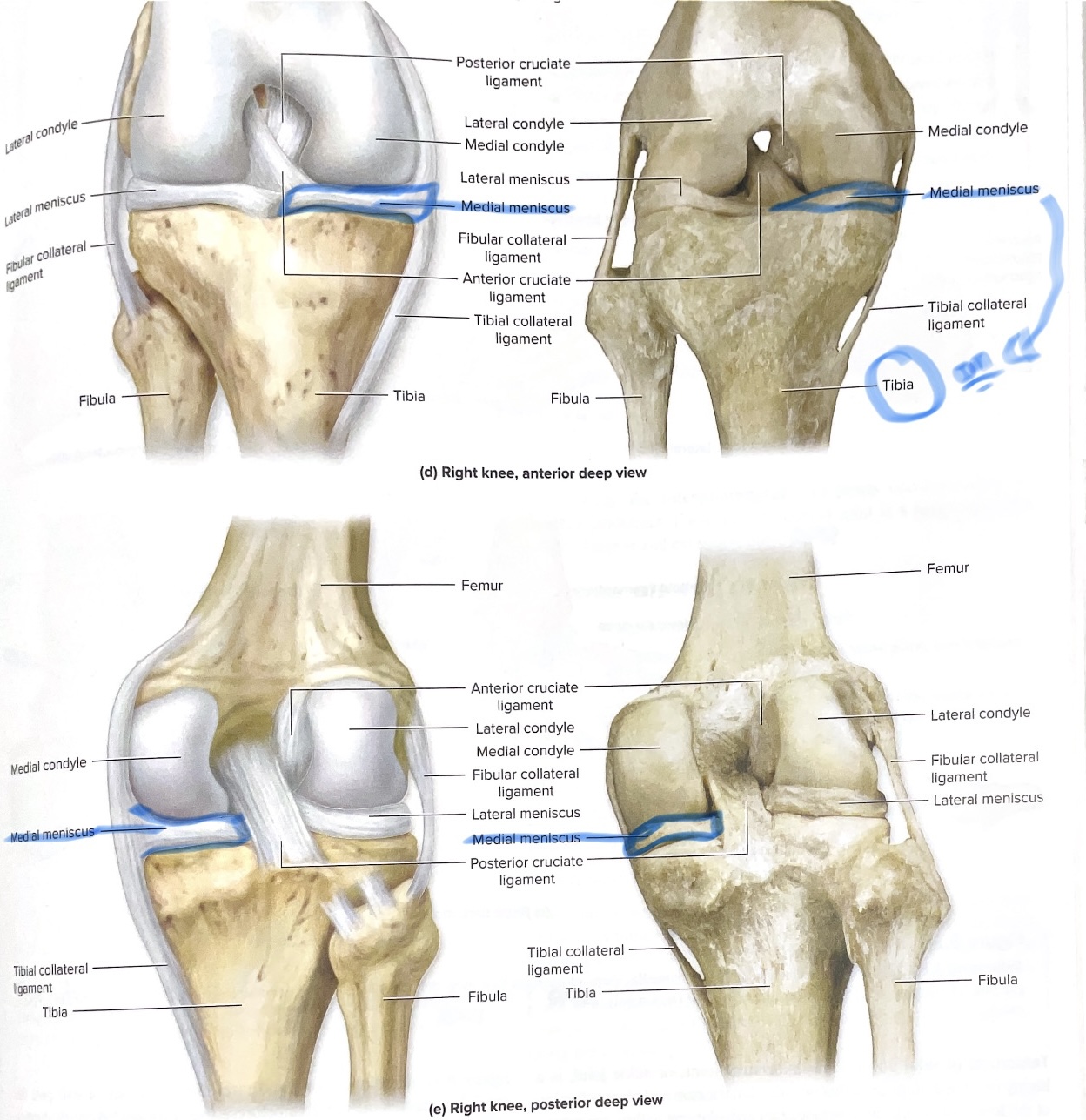 <p>Medial meniscus </p>
