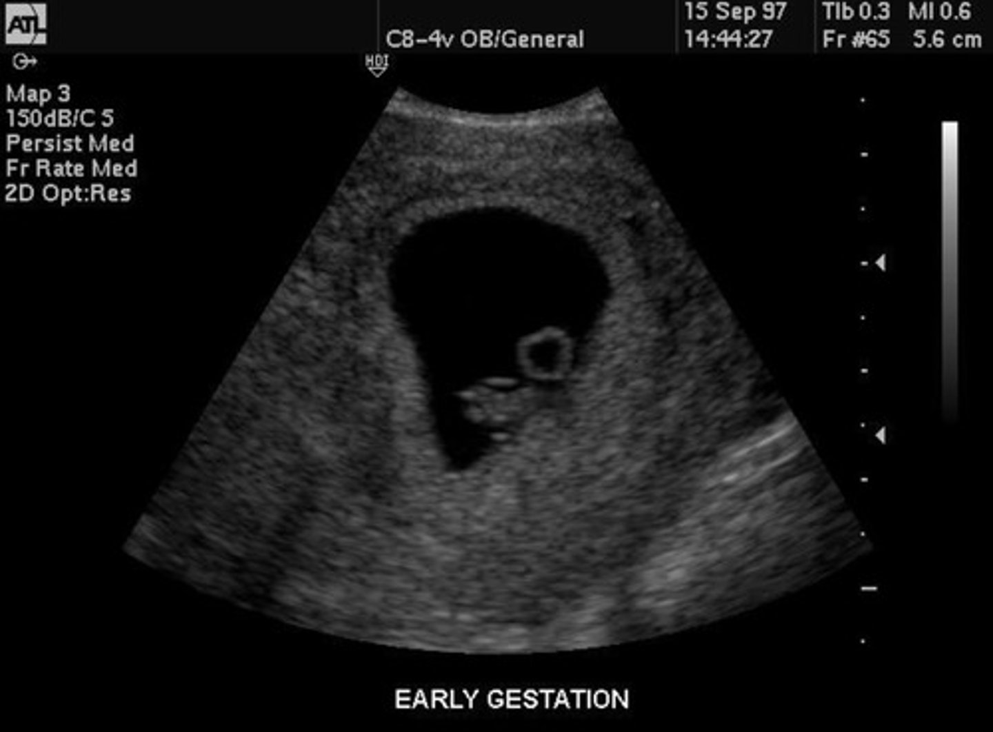 <p>Prominent brain development</p><p>Embryo seen with yolk sac and fetal pole</p><p>Heart beating</p><p>C-shaped embryo</p>