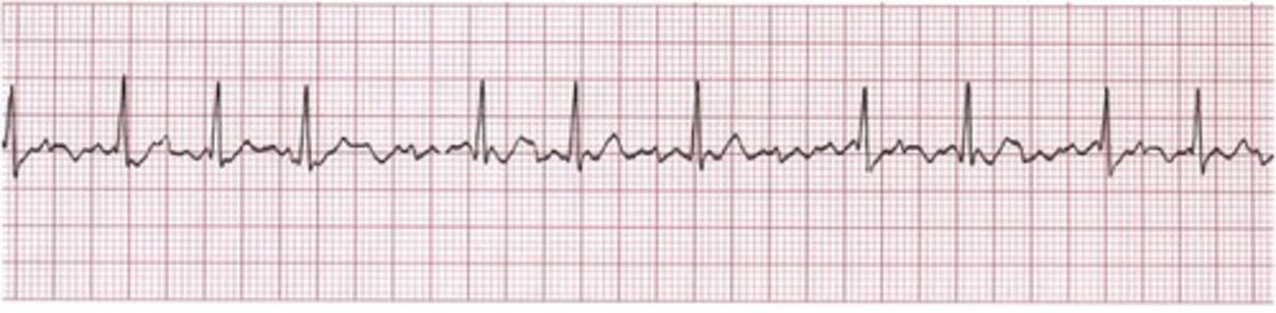<p>irregularly irregular</p><p>GOAL of treatment is to lower ventricular rate &lt;100</p><p>CCB, BB, and dig</p>