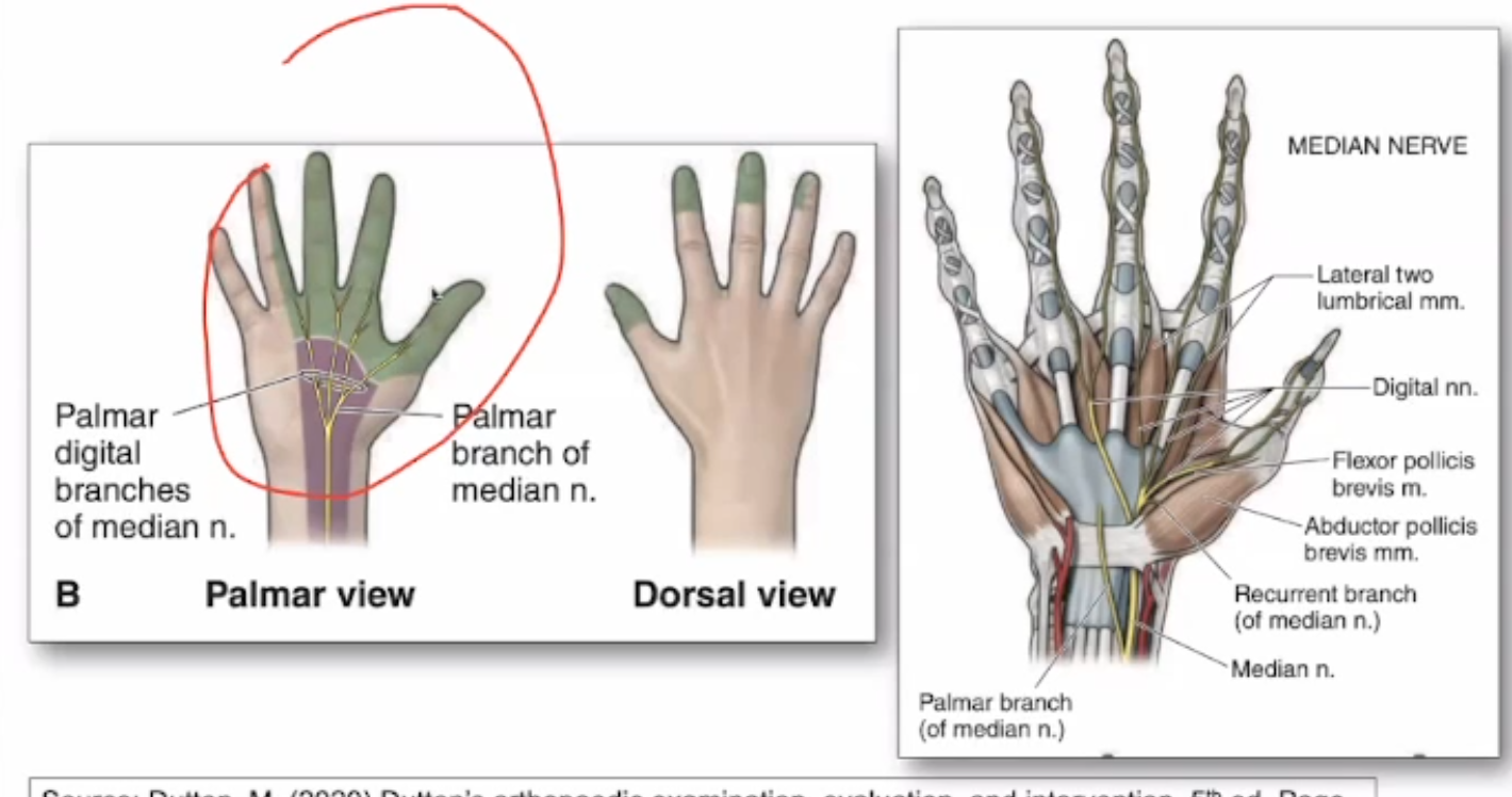 <ul><li><p>B, C&nbsp;</p></li></ul><p></p><ul><li><p>A - spared d/t innervation @ palmar cutaneous branch</p></li><li><p>D - ulnar nerve</p></li></ul><p></p>