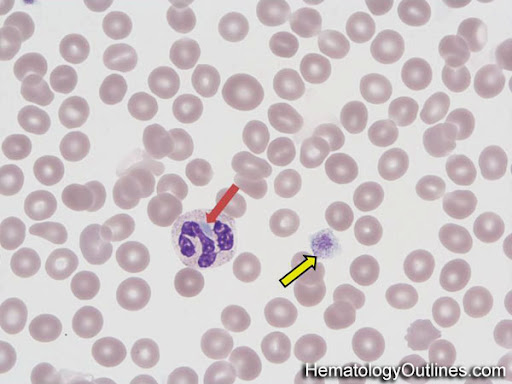<ul><li><p>associated with <strong>thrombocytopenia </strong>and <strong>giant platelets</strong></p><ul><li><p>patients present with <u>abnormal bleeding</u></p></li></ul></li><li><p>large Dohle bodies can be seen in the cytoplasm of neutrophils</p><ul><li><p><em>response to infection or inflammation</em></p></li></ul></li></ul><p></p>