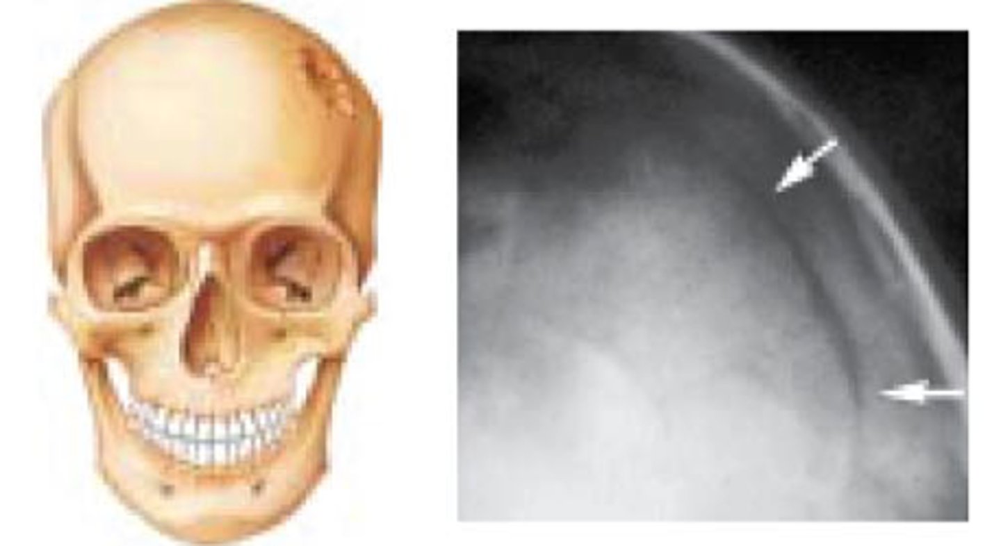 <p>Bone is broken into several irregular fragments that are pushed inward; direct underlying parenchymal damage; suspected when heads appears misshapen</p>
