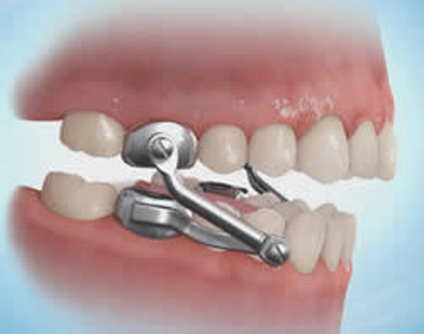 <p>fixed appliances that improves the overbite by encouraging lower jaw growth.</p>