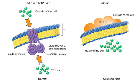 <p>A recessive disorder in humans that is caused by a mutant allele that encodes for a defective CFTR protein (cystic fibrosis transmembrane conductance regulator). Normally, this protein regulates ion transport across the cell membrane, but the mutated protein can’t do this and causes abnormalities in the pancreas, intestine, sweat glands, and lungs.</p><p>Heterozygous individuals (carriers) will produce enough CFTR for normal lungs function.</p>