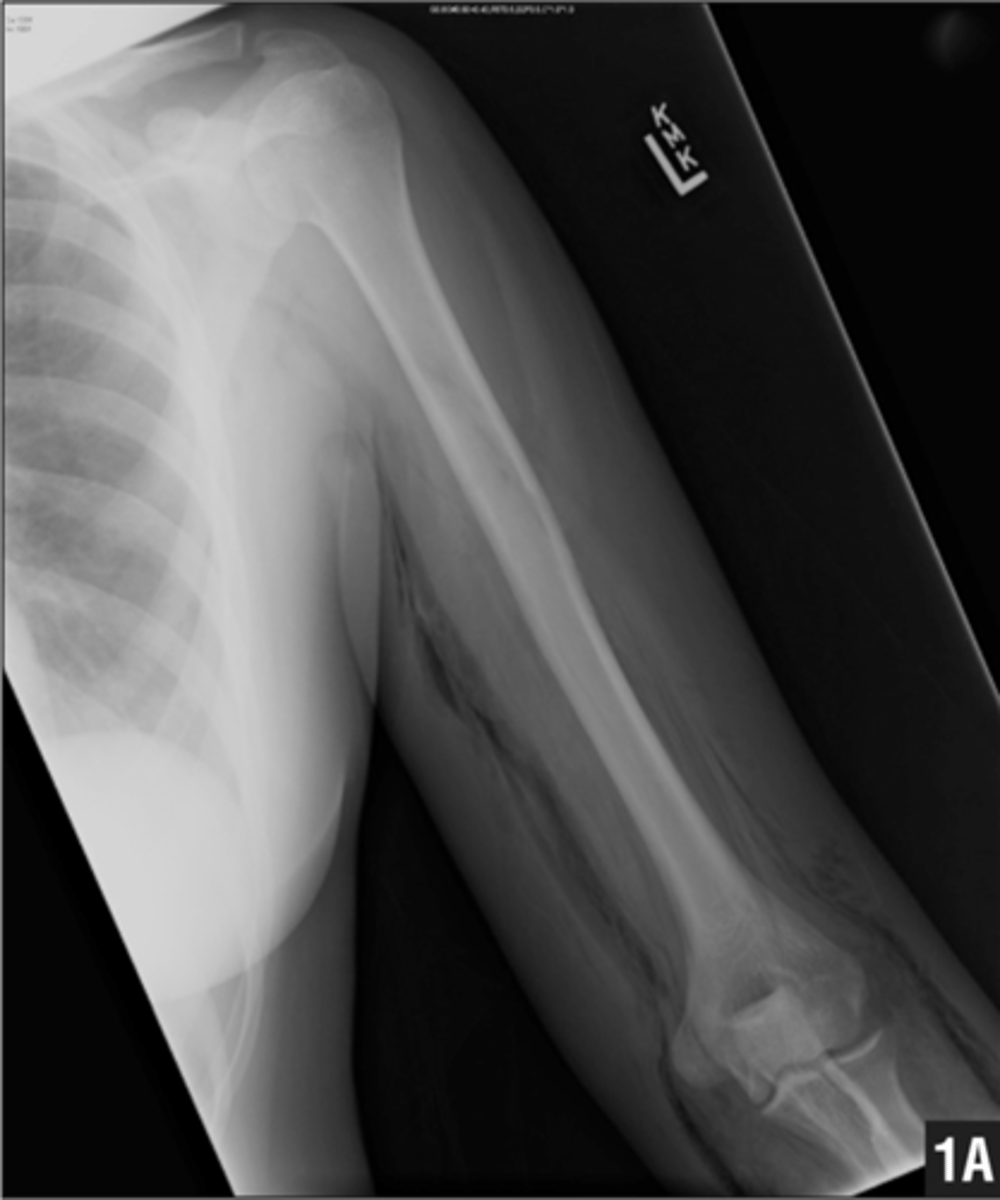 <p>white and light gray objects in the radiograph/ultrasound. bones and metal.</p>
