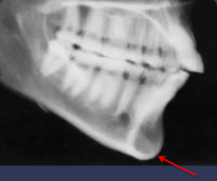 <p>Most inferior midline point on the mandible</p>