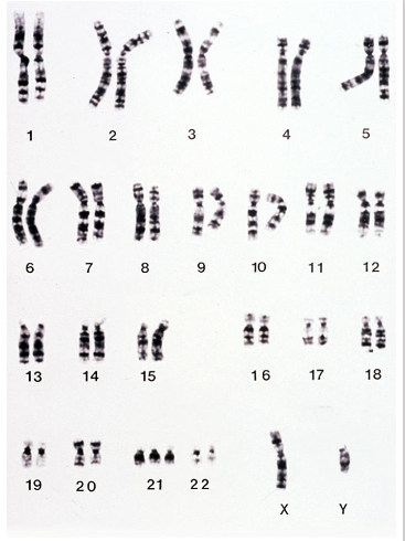 <p>- for final exam have to be able to look at a karyogram and tell if its normal or abnormal, if its XX or XY (without numbers beneath them)</p><p>- have an extra copy of one autosome</p><p>- in diploid organisms, autosomal trisomy generally results in abnormality or death</p><p>- however, can have viable trisomics and even fertile trisomics. e.g trisomy 21</p>