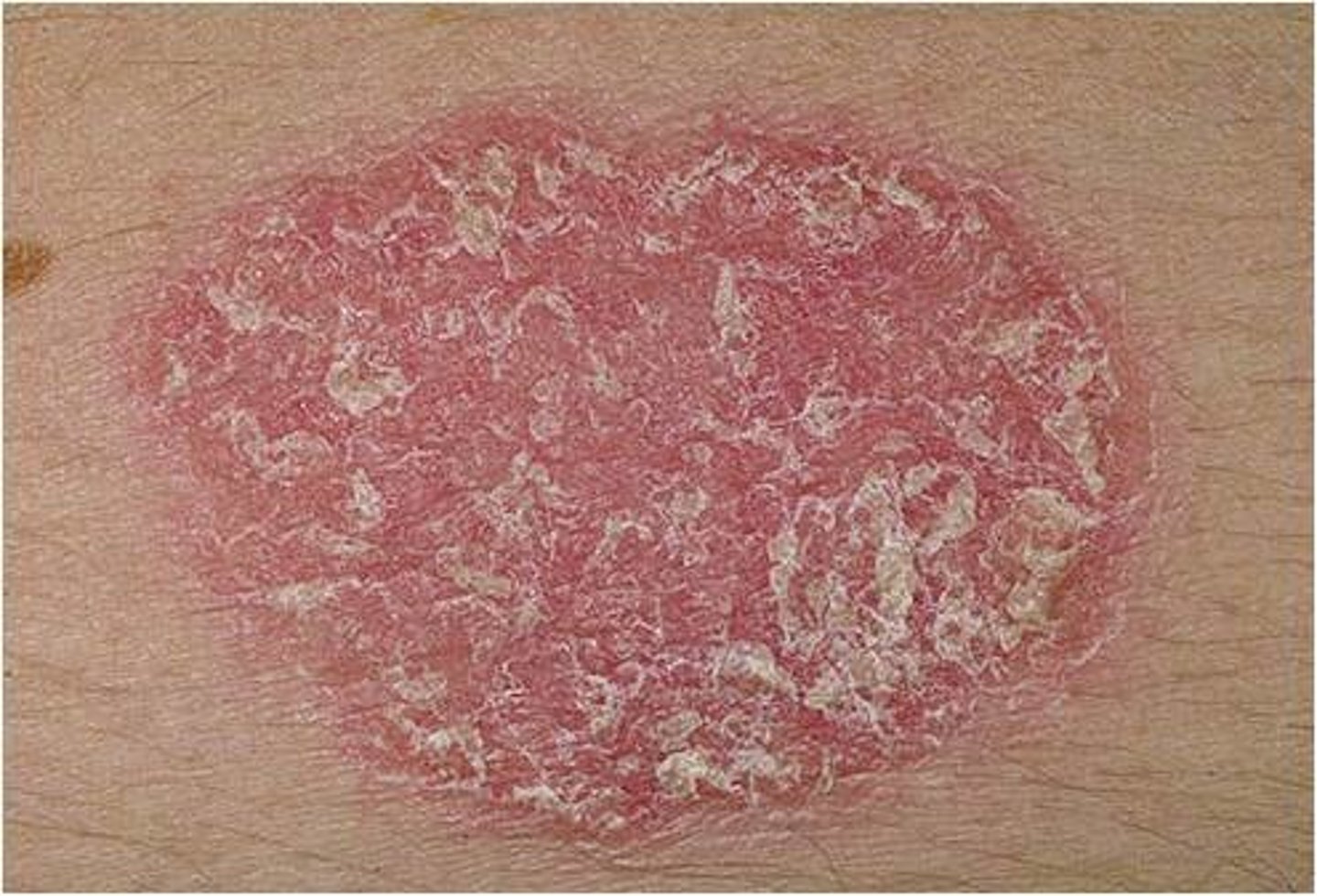 <p>Scales (secondary lesion)</p>