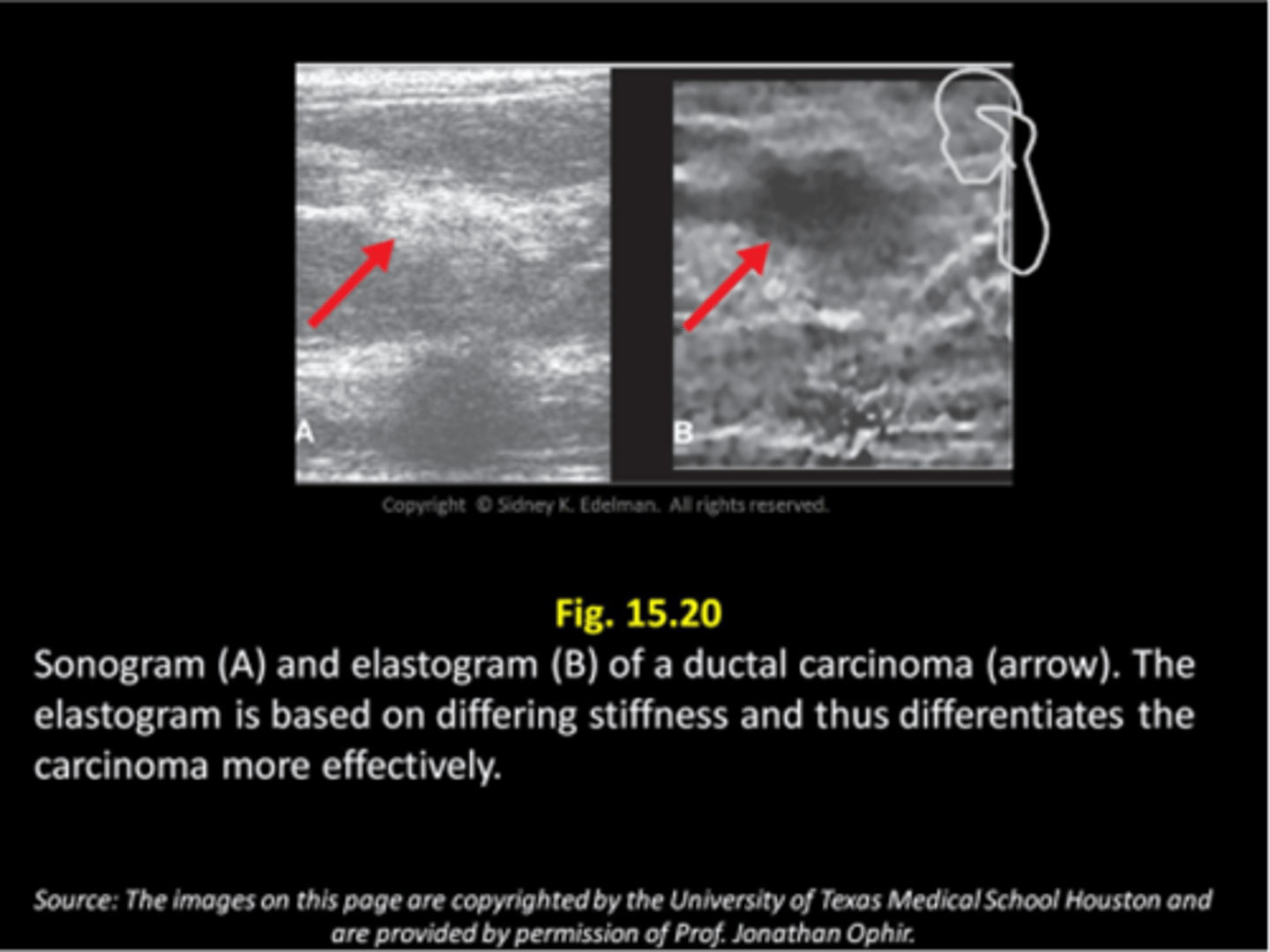 <p>elastography</p>