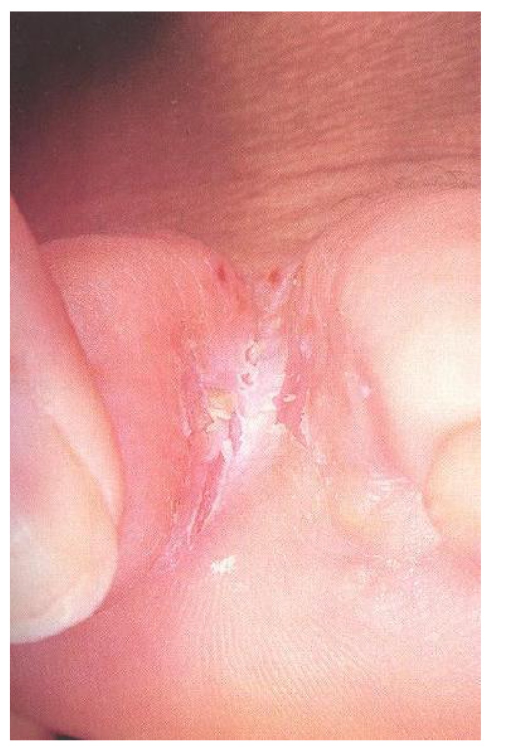 <p>what pattern of skin lesion is this? </p>