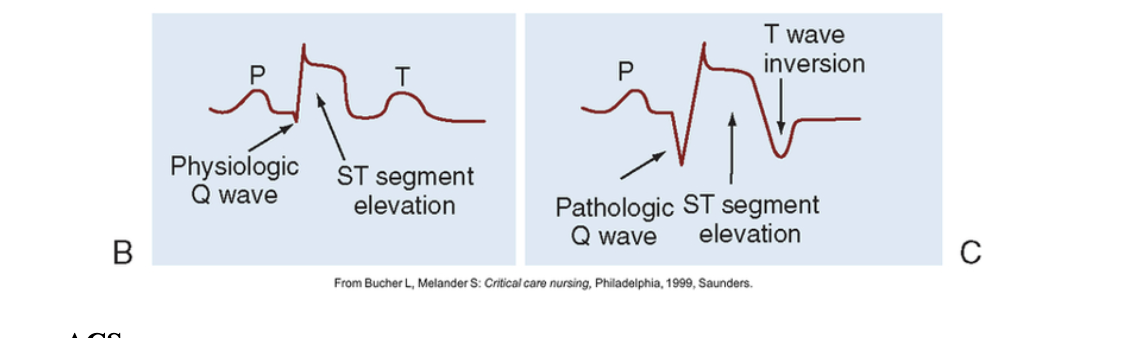 <ul><li><p><span style="background-color: transparent; font-family: "Times New Roman", serif;"><span>Includes UA and non-ST segment elevation myocardial infarction (NSTEMI) and ST segment elevation myocardial infarction (STEMI)</span></span></p></li></ul><p></p>