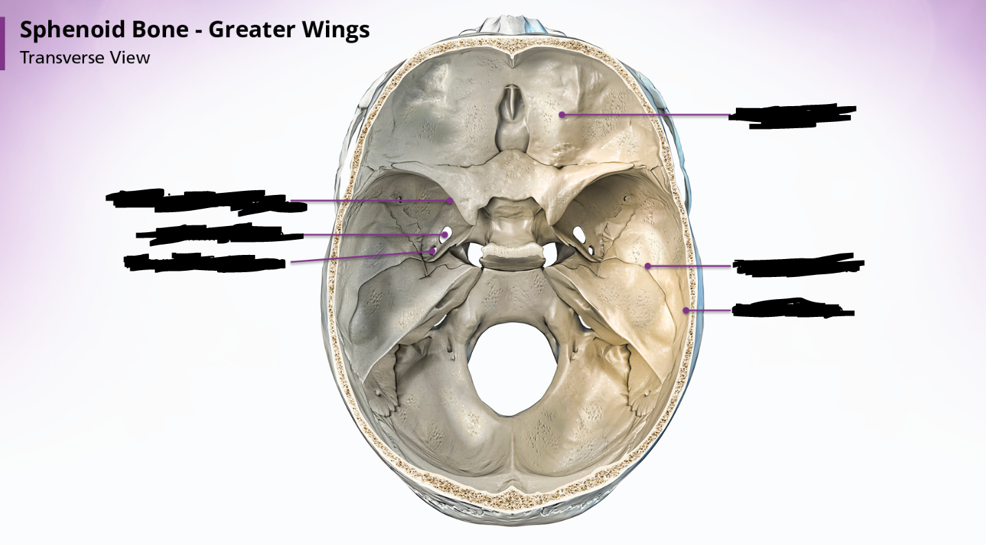 <p>sphenoid bone - greater wings</p>