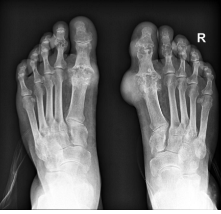 <p>most often affects the <span style="color: blue;"><strong><mark data-color="blue" style="background-color: blue; color: inherit;">metatarsal-phalangeal joint of the great toe</mark></strong></span> with the juxta-articular erosions and/or little to no osteoporosis&nbsp;</p><ul><li><p><span style="color: red;"><strong><mark data-color="red" style="background-color: red; color: inherit;">tophi = late manifestations of the disease</mark></strong></span></p></li></ul><p></p>