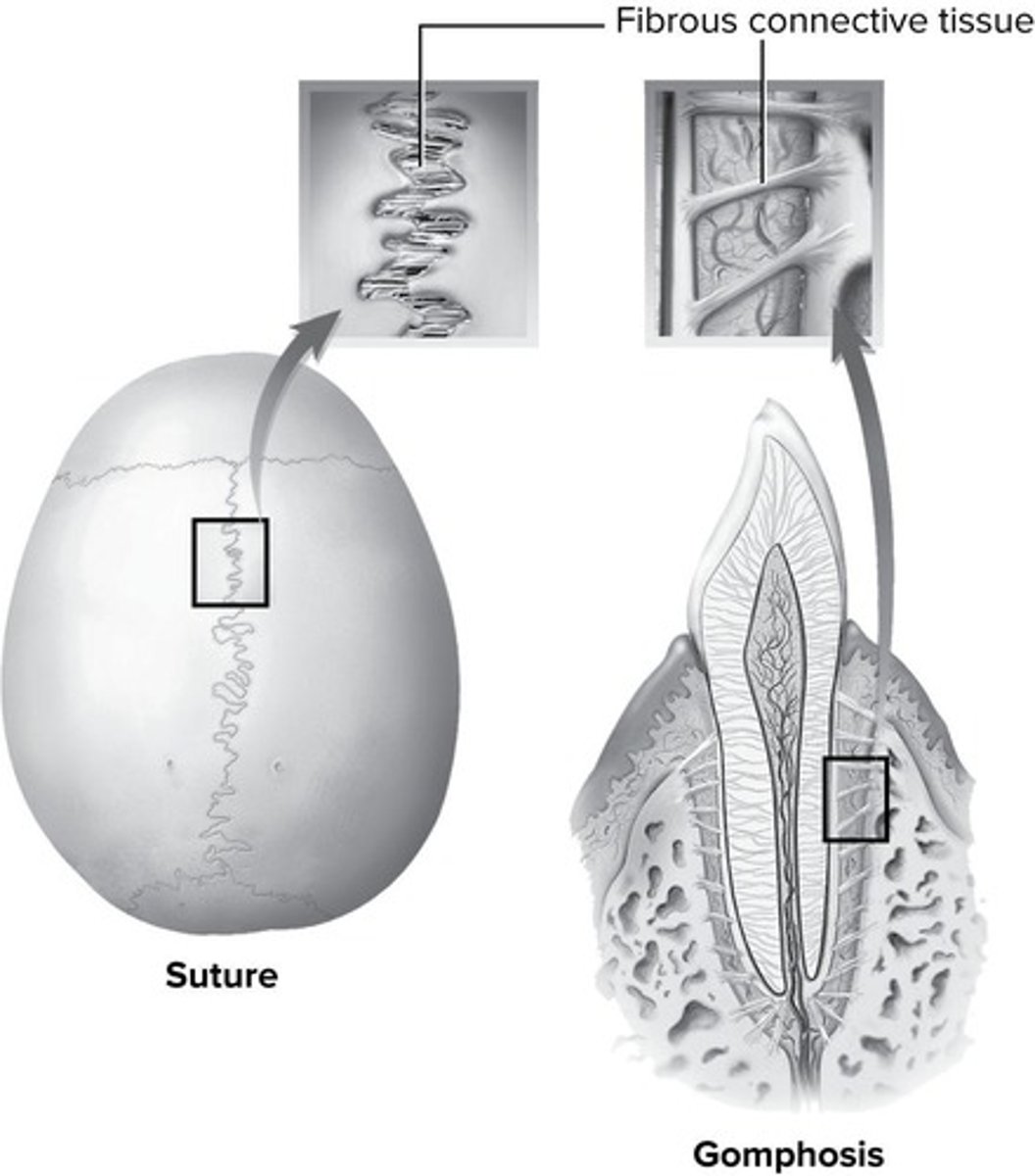<p>Immovable joints connected by dense connective tissue.</p>