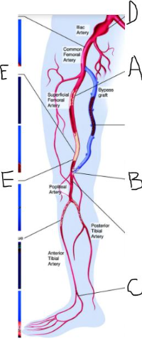 <p>Your patient has significant peripheral arterial disease and treatment! Label the structures and pathology identified by letters.</p><p>What is the name of the bypass graft?</p><p>Include laterality. </p>
