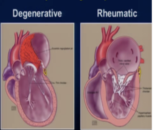 <p>If there is excess tissue or a loose or ruptured chordae that is cause of the MR. This is called___________________.</p>