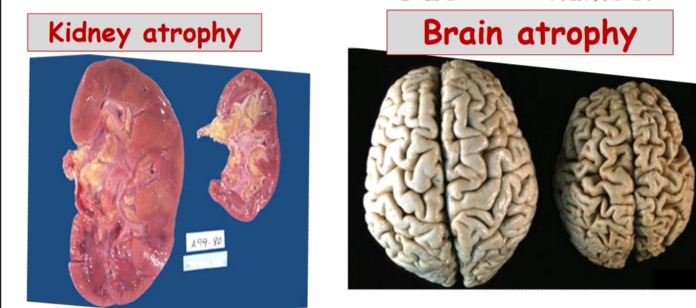 <p>1- kidney atrophy </p><p>2-brain atrophy</p><p>Atrophy: decrease in size of mature organ due to decrease in cell size (and ,or) number</p>