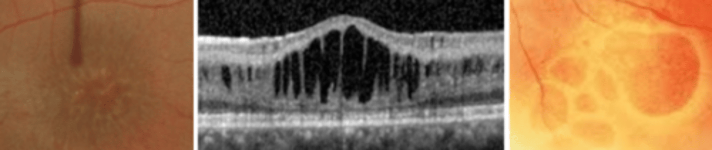 <p>x-linked bilateral maculopathy associated with peripheral retinoschisis due to a defect in Muller cells splitting the NFL from the sensory retina occurring at the OPL. Presents 5-10 years being slowly progressive. Secondary changes include oval defects of the ILM that coalesce and leave free floating blood vessels in the vitreous. Parent education and referral to retina.</p>