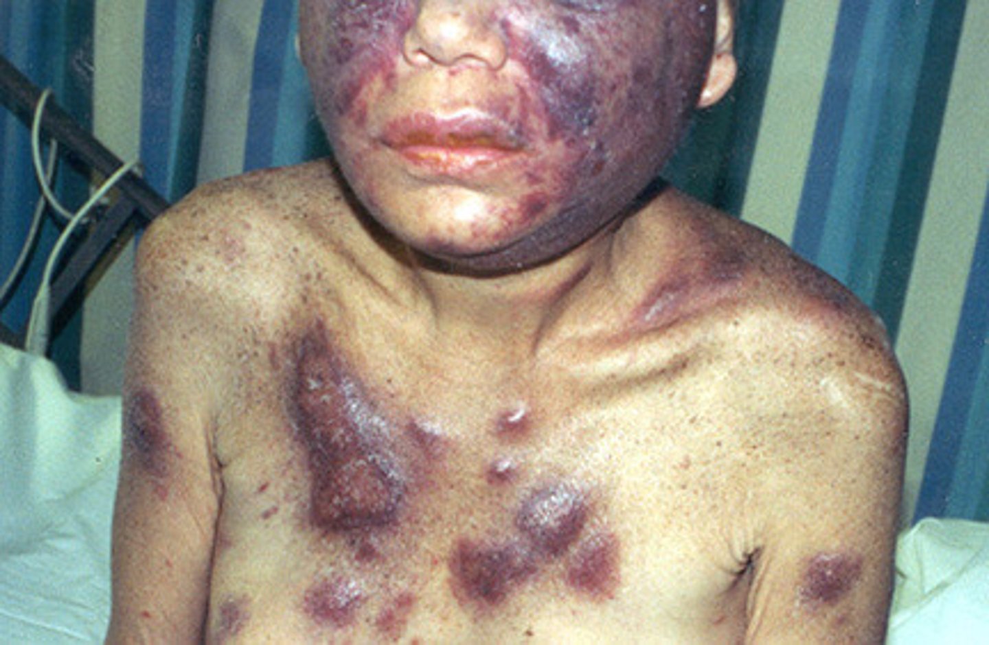 <p>Kaposi Sarcoma, associated with HHV-8</p><p>Endothelial cell tumor, not of blood vessels (will not blanche)</p><p>Spindle cells</p><p>Spreads via blood</p>