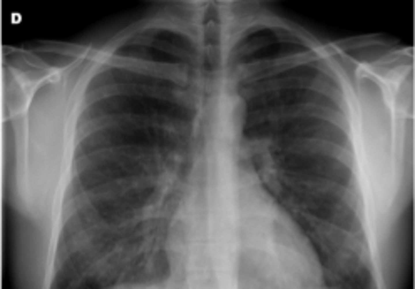 <p>Larval stage hookworms that penetrate deep and reach the pulmonary circulation</p><p>-Nonspecific respiratory illness, dry cough, dyspnea</p><p>-Diffuse pulmonary infiltrates on xrays</p>