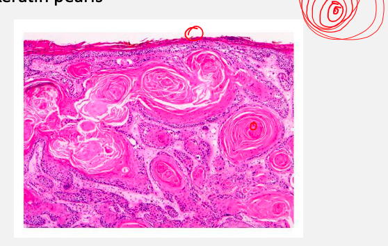 <p><strong>Formation of keratin pearls</strong> (concentric layers of keratinized squamous cells)<span style="color: blue;"> *note: no nucleus present (how we distinguish with basal cell carcinoma)</span></p>