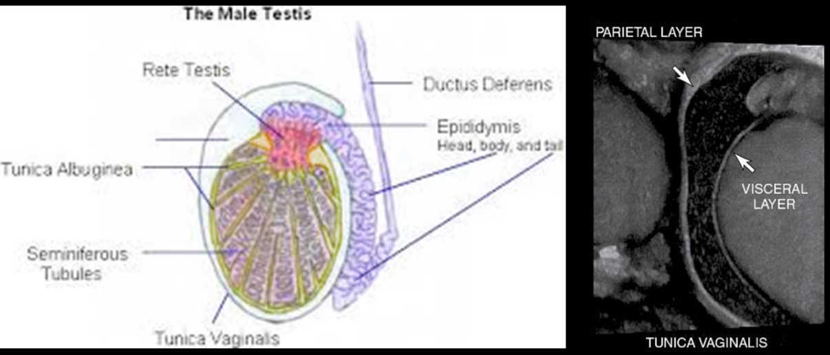 <p>What is a saccular extension of peritoneum in chambers?</p><p>–Inner, visceral layer covers testis and epididymis</p><p>–Outer, parietal layer lines chamber</p>