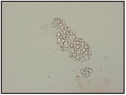 Casts seen in conjunction with oval fat bodies and free fat droplets in disorders causing lipiduria
