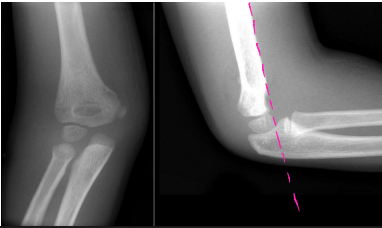 <p>What type of humerus fracture am I describing?</p><p>-Fracture of distal humerus just above the epicondyles </p><p>-Check nerve function during examination → radial, ulnar, and median nerves can be damaged</p>