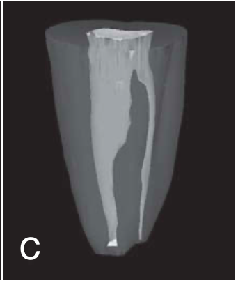 <p><span>asymmetrical type</span></p><p><span>separated mesial and distal canals, with the distal canal having a long isthmus across the furcation area</span></p>