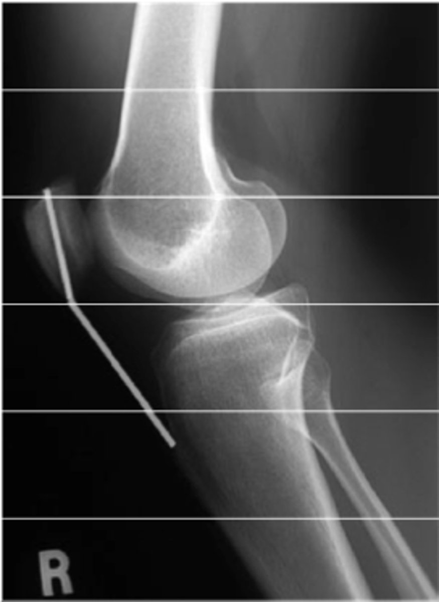 <p><strong>Lower Extremity Knee</strong> Plain films include:</p><p></p><p><strong>_________________</strong> – patella and joint effusions</p>