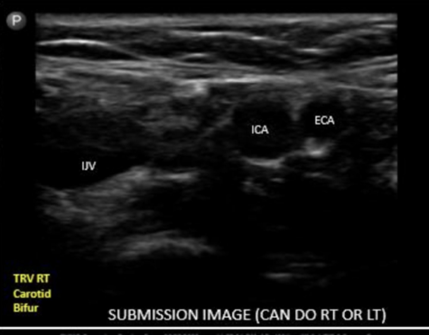 <p>ECA is usually more anterior and medial</p>