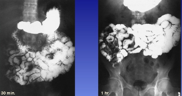 <p>What is this x-ray demonstrating?</p>