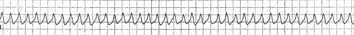 <p>a fast heart rhythm originating from the ventricles, typically characterized by dominant wide QRS complexes and can lead to Vfib or cardiac arrest </p>