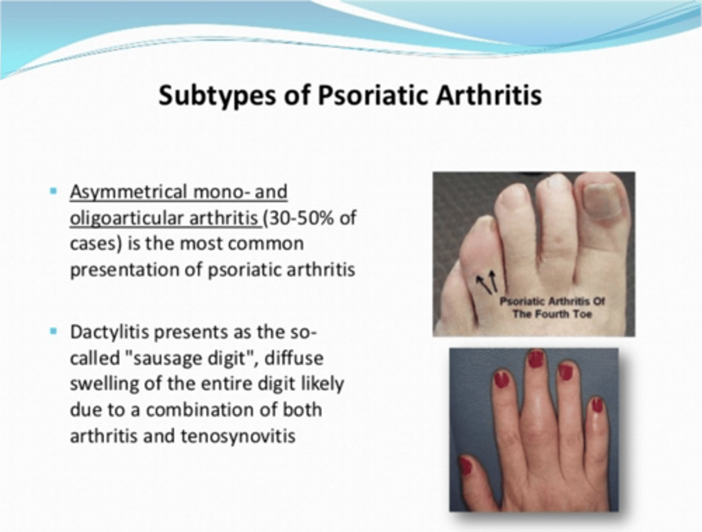 <p>- asymmetric oligoarthritis with dactylitis (sausage fingers)</p><p>- DIP arthritis</p><p>- RA-like polyarthritis</p><p>- spondylitis</p><p>- arthritis mutilans</p><p>- HIV related</p>