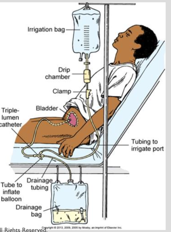 <p><strong>TURP with CBI</strong></p><ul><li><p>transurethral resection of the prostate</p></li></ul><p></p><p>Post OP of TURP = can have issues with infection, incontinence, and bleeding</p><ul><li><p>triple lumen catheter is useful for continuous bladder irrigation</p></li><li><p>can prevent infection and decrease risk of bleeding and clots</p></li></ul><p></p><p>Need to take strict I&amp;O’s</p><p></p><p>Expected</p><ul><li><p>Hematuria!</p></li></ul><p></p><p>Unexpected</p><ul><li><p>A lot of serosanguinous blood</p></li><li><p>low VS —&gt; hypovolemic shock —&gt; call doctor</p></li></ul><p></p>