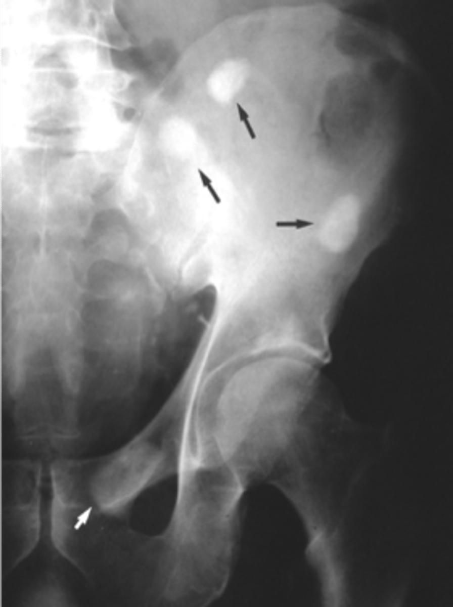 <p>ID pelvis osteoblastic pattern</p>