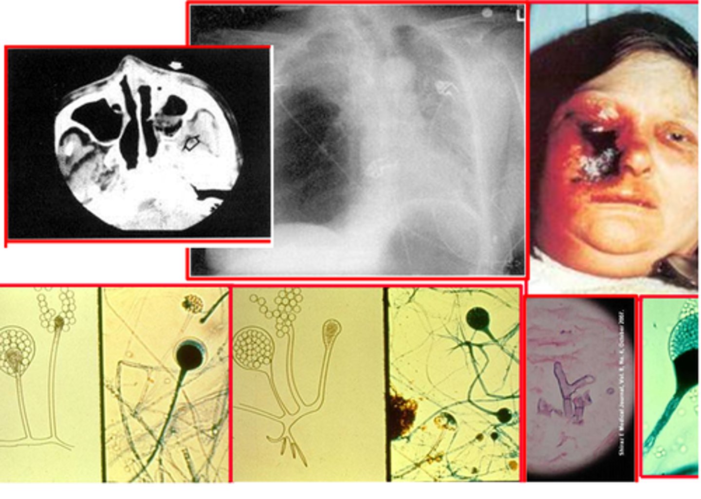 <p>Formerly zygomycetes - mucormycosis is a rare but serious respiratory fungal infection from <strong>immunocompromised</strong> individuals being exposed to the fungus in the environment (increase in cases post-COVID recovery)</p>