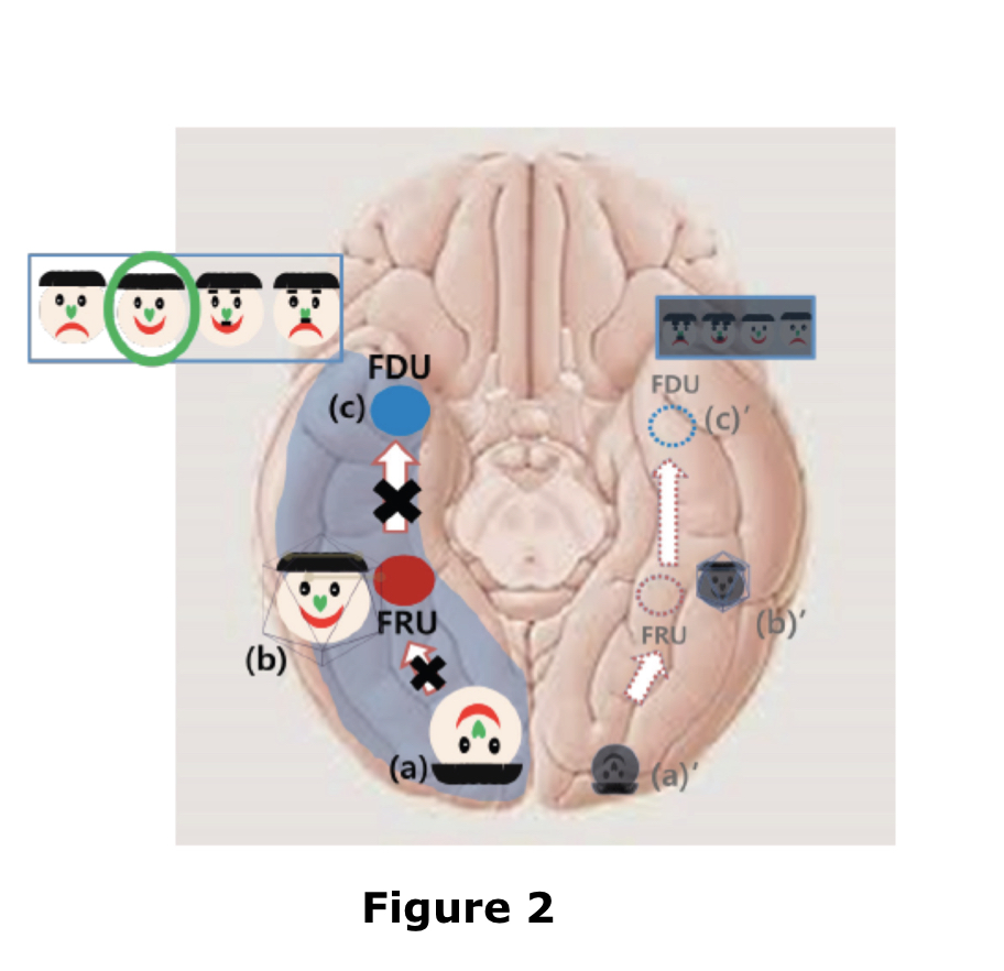 <p>type of visual agnosia - difficulty visually identifying familiar faces</p><ul><li><p>can be observed in patients with semantic dementia or bilateral posterior cerebral artery territorial - damage to bilateral occipitotemporal areas (gyri) is necessary</p></li><li><p>this patient had unilateral damage while exhibiting these symptoms, so damage criteria has expanded</p></li><li><p>can still occur with no abnormality in visual perception</p></li><li><p>patient could not identify photos of celebrities/well known people</p></li><li><p>shows lesions in fusiform gyrus from occipital to temporal pole</p></li></ul><p></p>