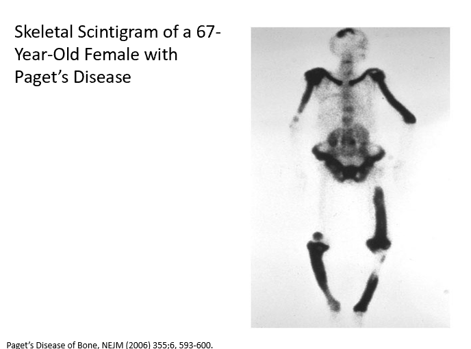 <p>What causes progressive pain in the shins, knees, and left arm in Paget’s Disease?</p><ul><li><p>Due to increased bone density! Osteoblasts aren’t regulated. Too much_</p><p></p></li></ul><p></p>