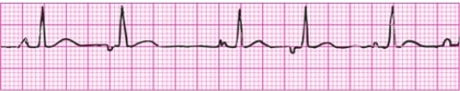 <p>Average HR <100, Irregular, at least 3 different P wave shapes, variable PR interval with narrow <0.12 sec QRS</p>