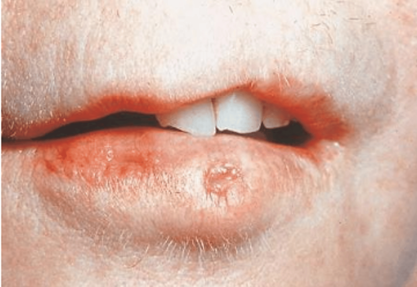 <p>Van der Woude Syndrome (Cleft Lip-Palate and Congenital Lip Pits)</p>