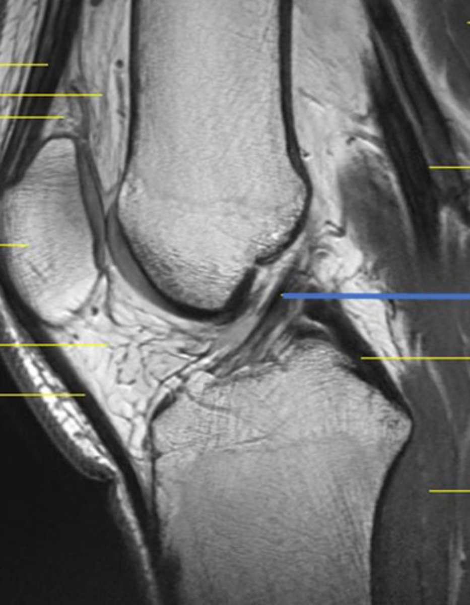 <p>ACL</p><p>3 multiple choice options</p>