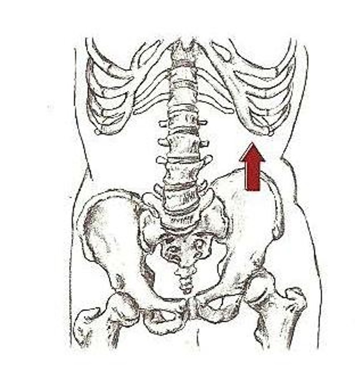 <p>one side of the pelvis is lower than the other side, which can lead to scoliotic posture and pressure ulcers on the ischial tuberosity</p>